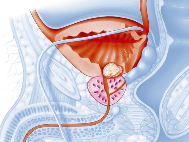 La forma batterica di prostatite